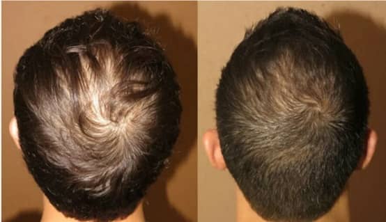 Profollica Results Before and After